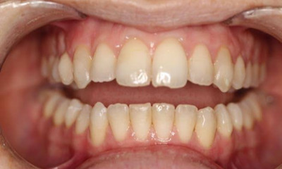 After treatment - Clear Aligners and Enamoplasty