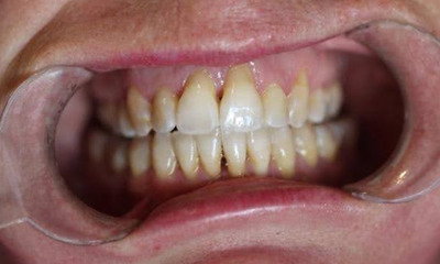 After treatment - Clear Aligners