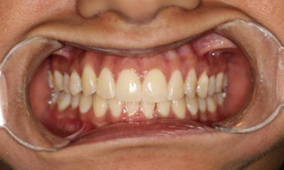 After treatment - Clear Aligners
