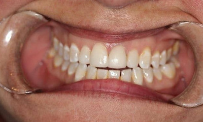 After treatment - Crown Replacement