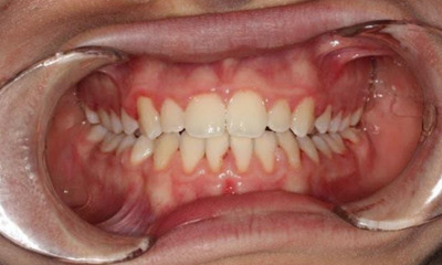 After treatment - Fixed Braces and Expander