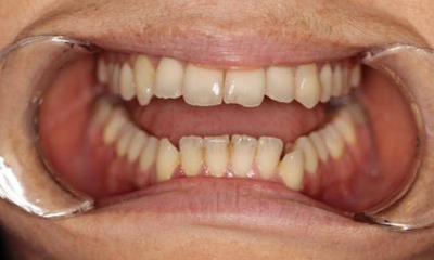 Before treatment - Clear Aligners and Enamoplasty