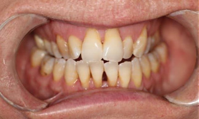 Before treatment - Clear Aligners