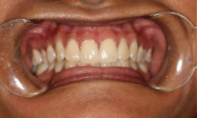 Before treatment - Clear Aligners