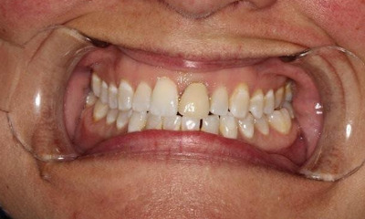 Before treatment - Crown Replacement