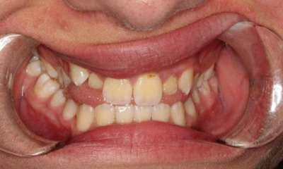 Before treatment - Fixed Braces and Expander