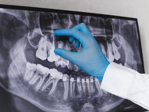 Panoramic X-Ray